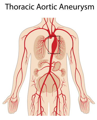 AORTIC ANEURYSMS AND AORTIC DISSECTIONS