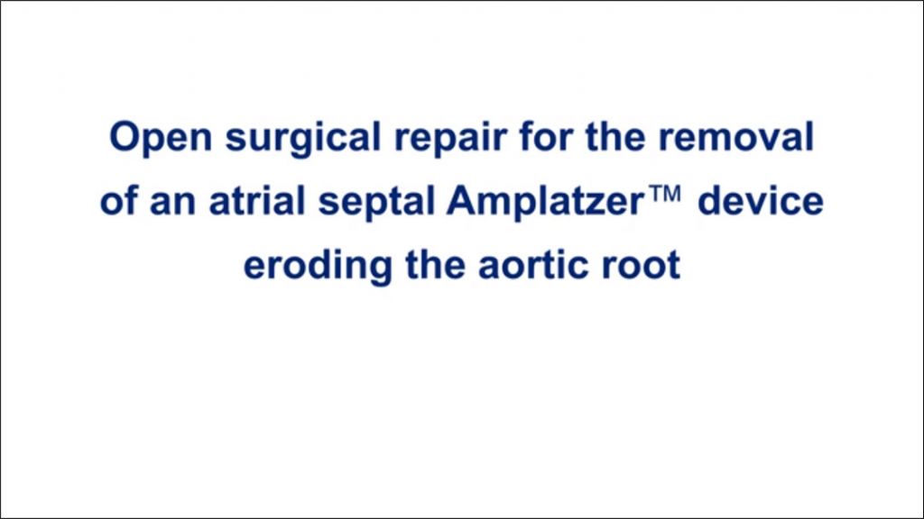 Repair of a Complication from Another Hospital ( Atrial Septal Defect repair device that punctured the Aortic Root)