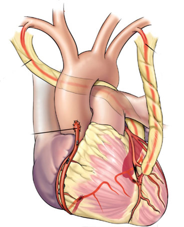 CORONARY ARTERY DISEASE – BYPASS OPERATION