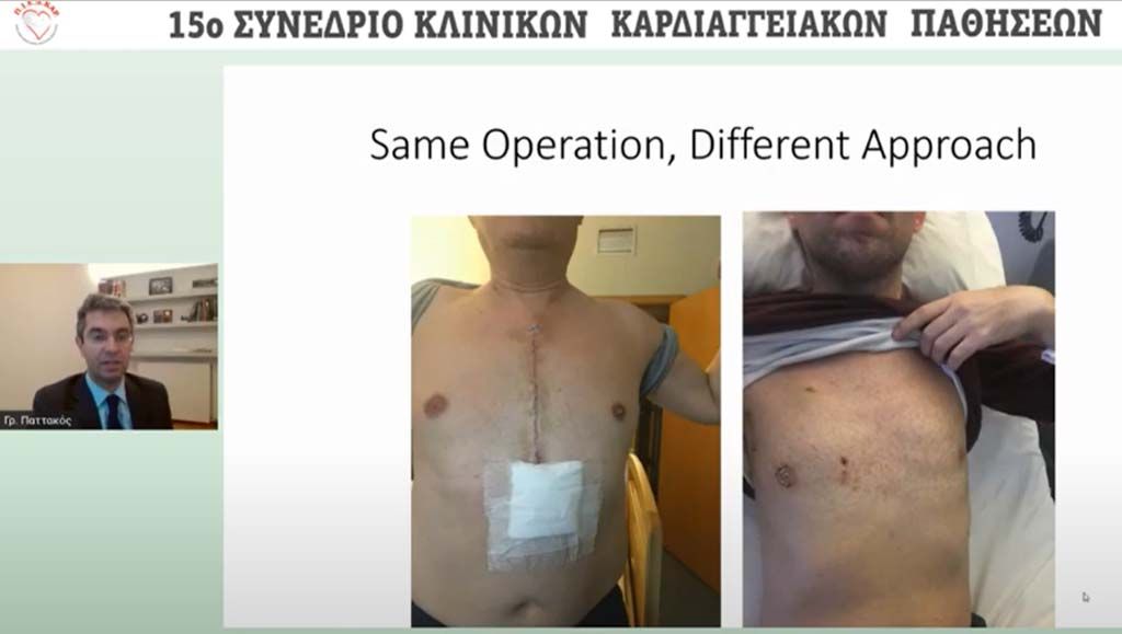 Cardiac Surgery of Heart Valves and Aortic Aneurysms without Sternotomy